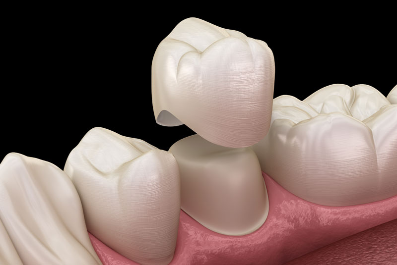 dental crown model