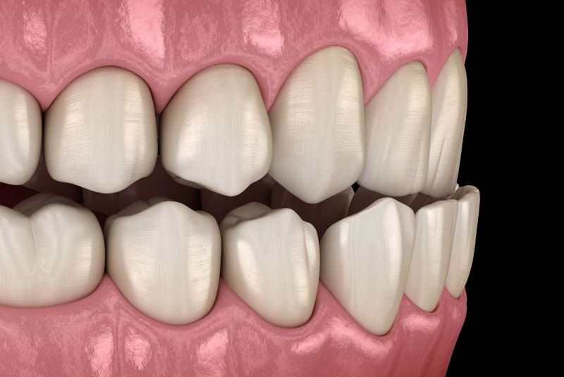 dental occlusal