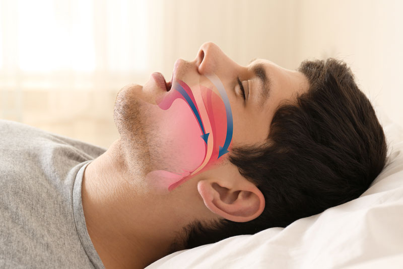 sleep apnea graphic