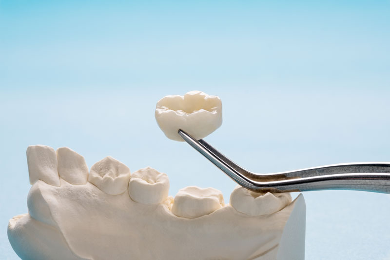 a crown getting placed onto a prop jaw
