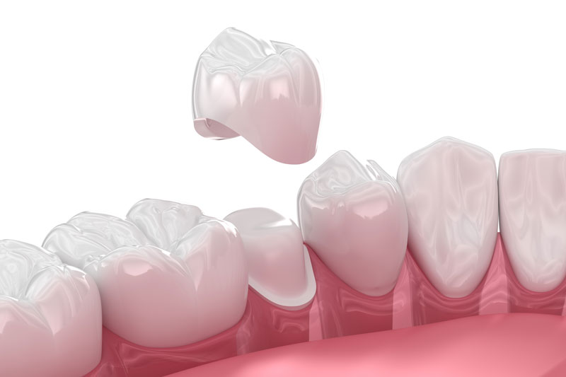 a crown being placed onto a shaved tooth showing the layers