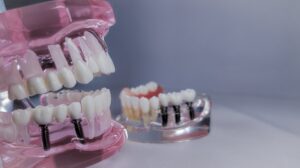An animated illustration showing a step-by-step visual guide of the "teeth implants process", from initial consultation to final crown placement, with each step clearly labeled. No text on image.